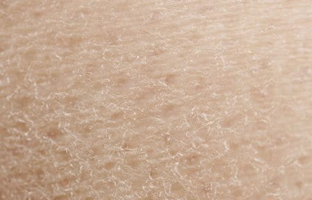 Woman´s face with dry skin