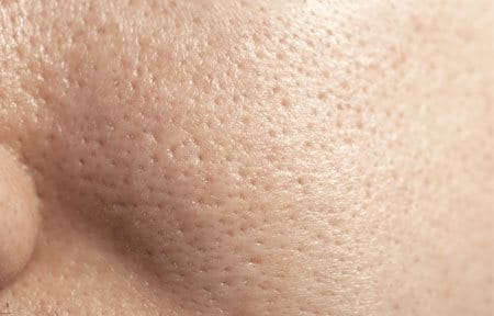 Woman´s face with oily skin