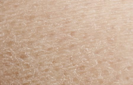 Close up from dry skin