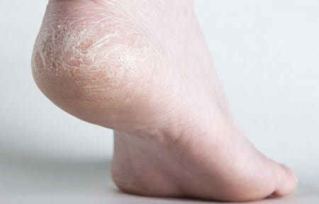 Close up from cracked heel