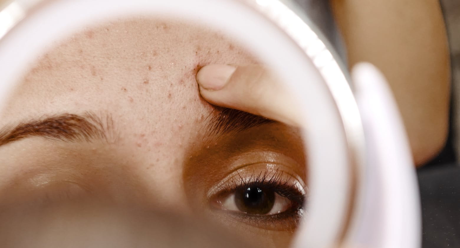 los diferentes tipos de acne acne