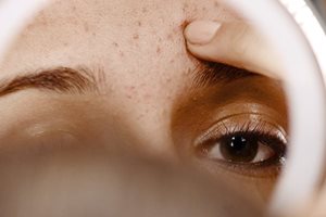 Acne comes in different types and forms