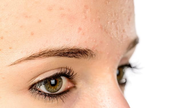 picture Mallorcan Acne the different types of acne acne
