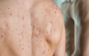 wallpapers Mallorcan Acne the different types of acne acne
