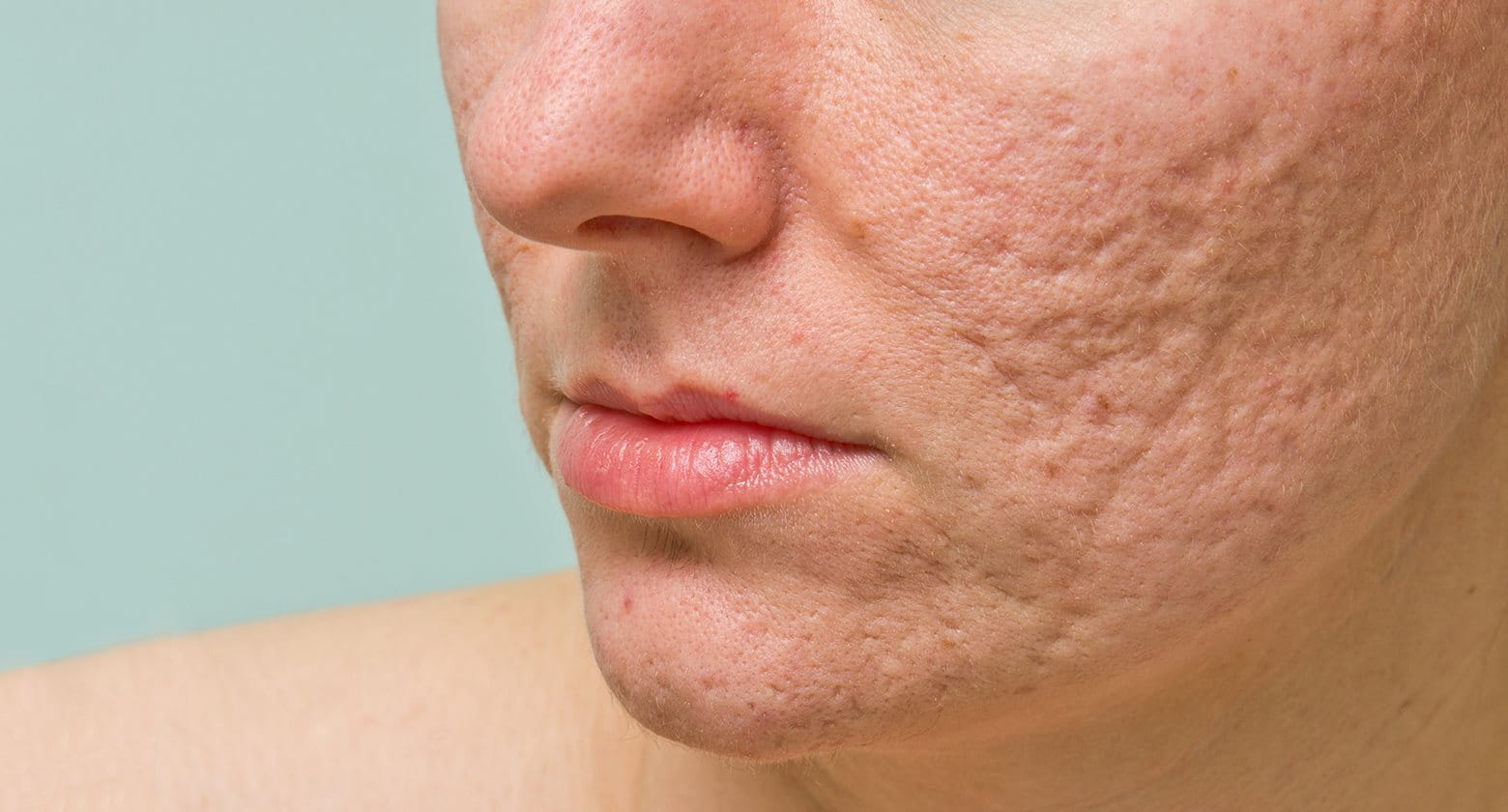 Treating and removing acne scars