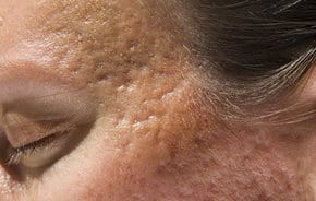 Cicatrici Da Acne Rimedi Per Eliminarle Eucerin