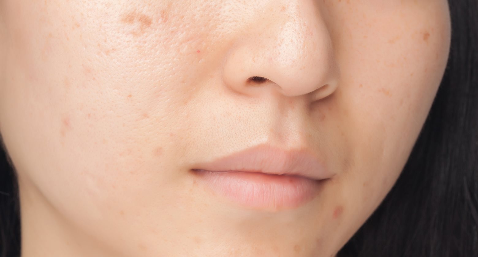 Pimple marks can be reduced and removed