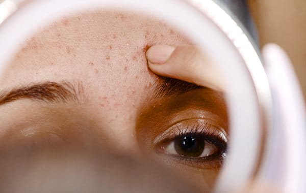 acne specialist doctor