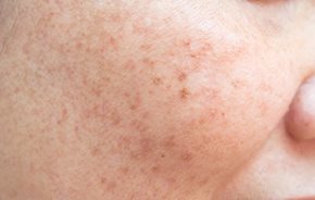 The sun can have a negative influence on acne-prone skin