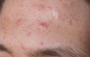 Acne papulo-pustular, moderate acne