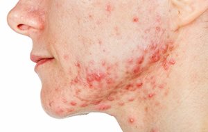 Severe acne