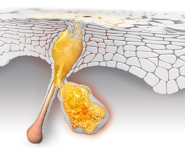 Wie Lassen Sich Mitesser Entfernen Akne Eucerin