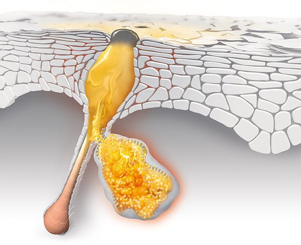 Wie Lassen Sich Mitesser Entfernen Akne Eucerin