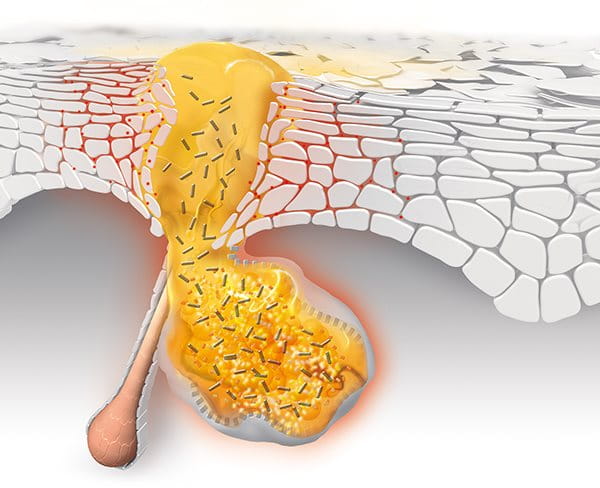Pickel - Pickel Am Kinn Finde Die Richtige Losung Fur Dich Faces Of Fey : Pickle definition, a cucumber that has been preserved in brine, vinegar, or the like.