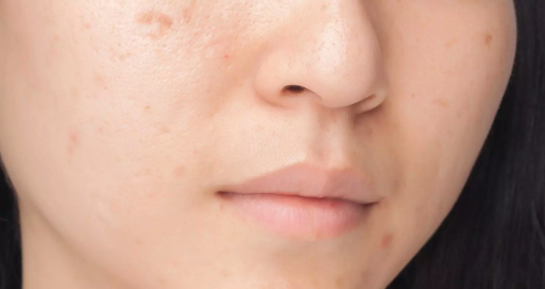 Marques Acne Effets Sur La Peau Eucerin