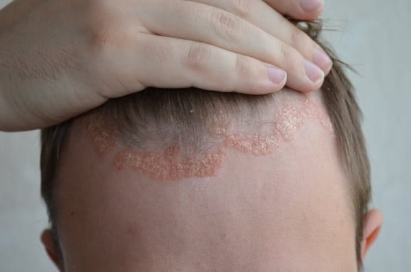 Ekzeme - Symptome, Arten und Pflegetipps - Eucerin