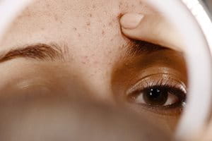 Acne comes in different types and forms