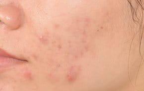 Pickelmale Folgen Von Akne Eucerin