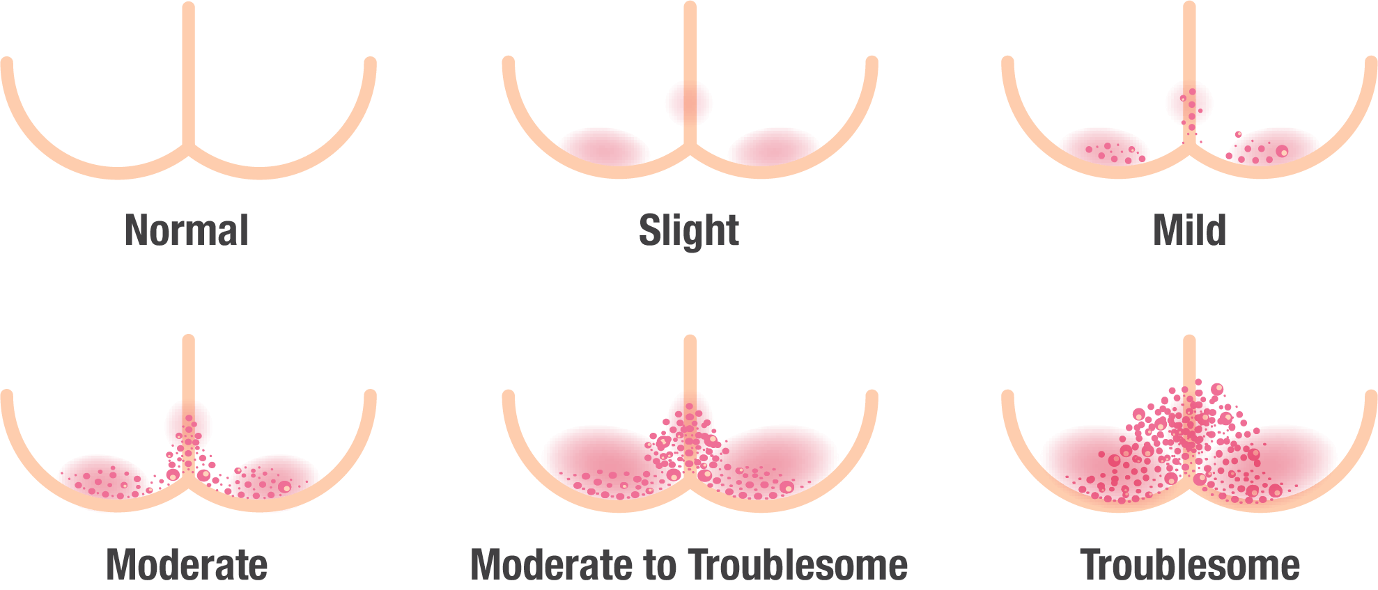 medical illustration showing different degrees of diaper rash