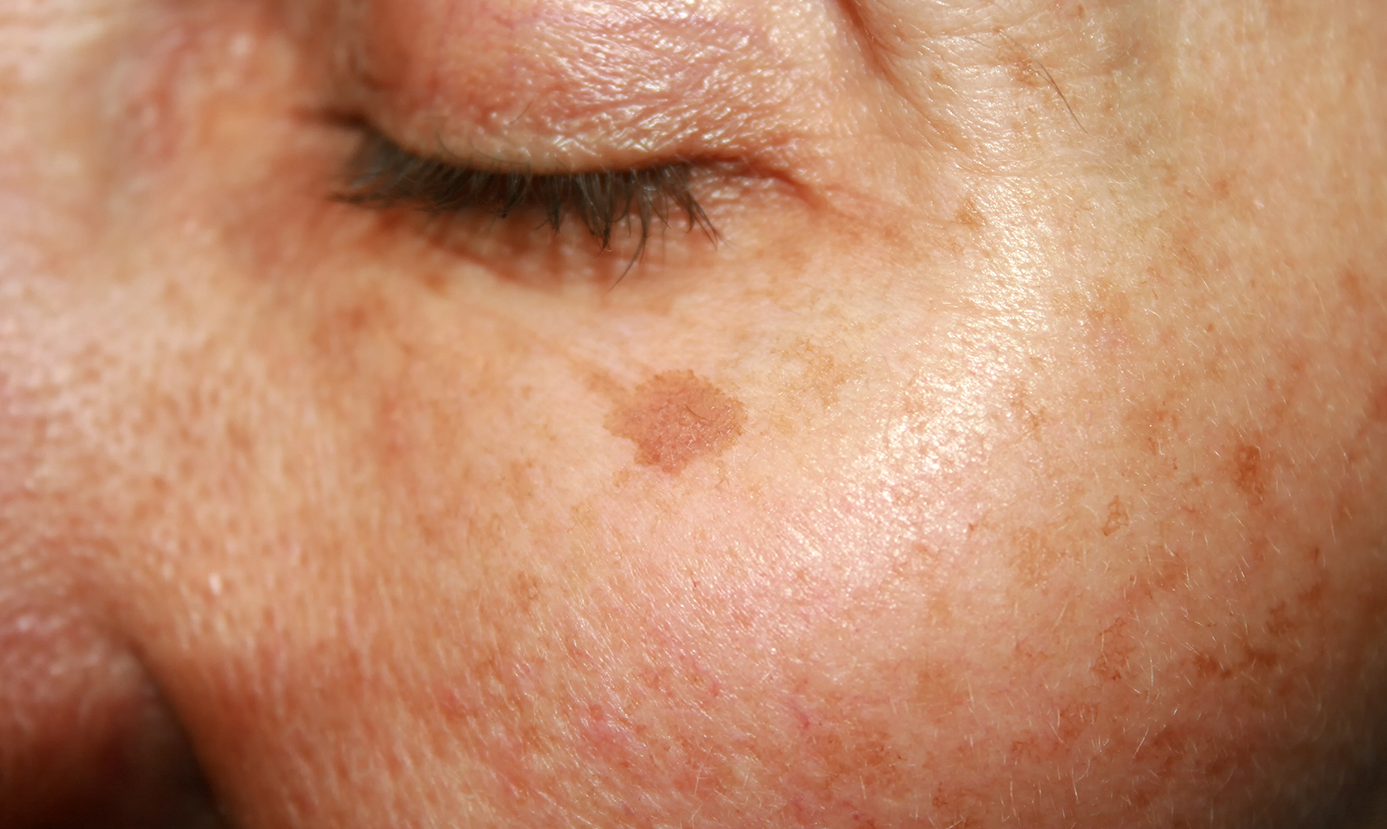 Eucerin njega, postupalna hiperpigmentacija