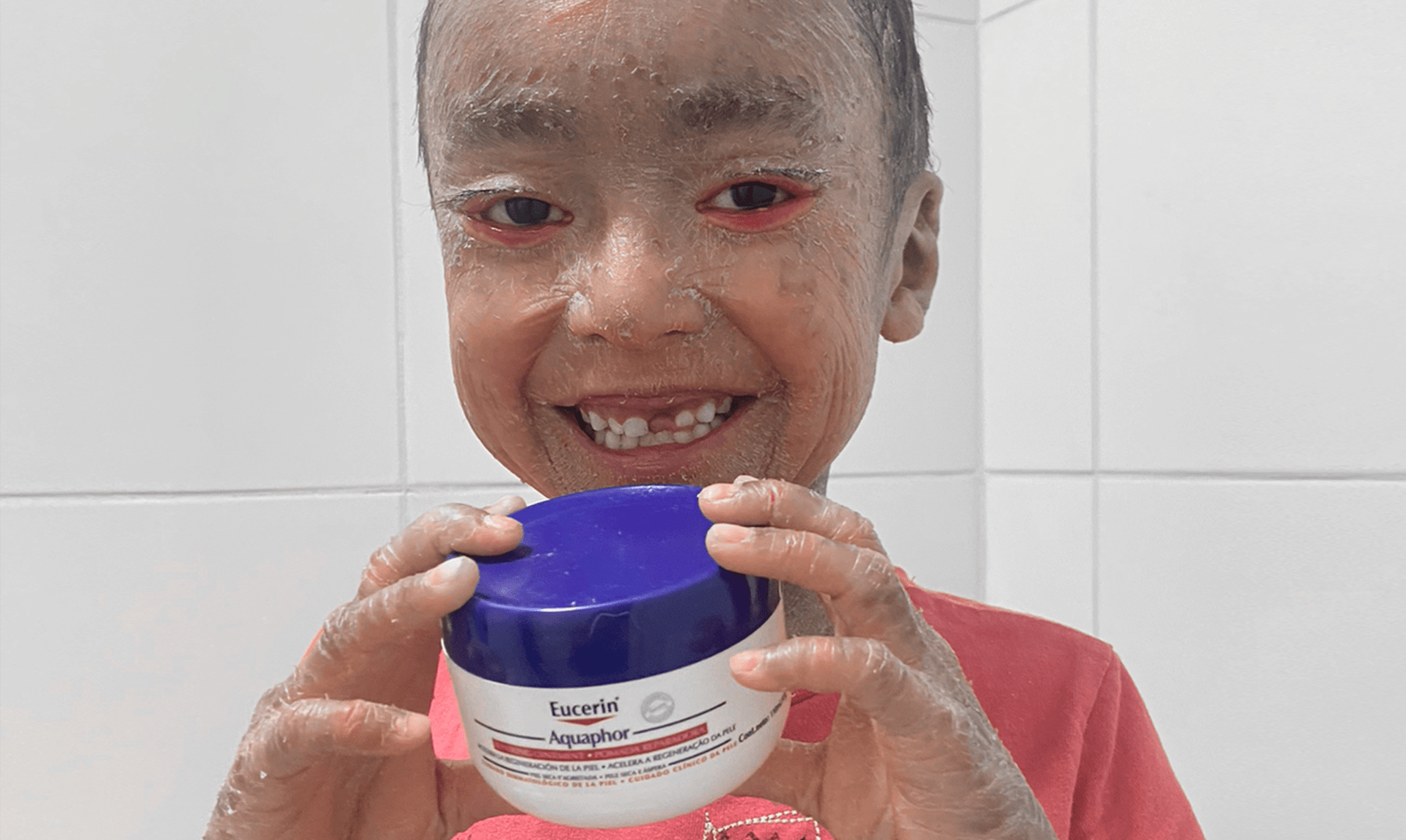 ENCOUNTER / PSORIASIS Project in Germany 