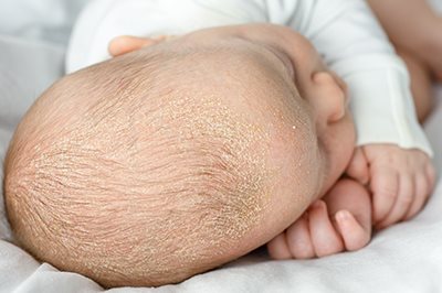 baby mit milchschorf atopische dermatitis bei baby