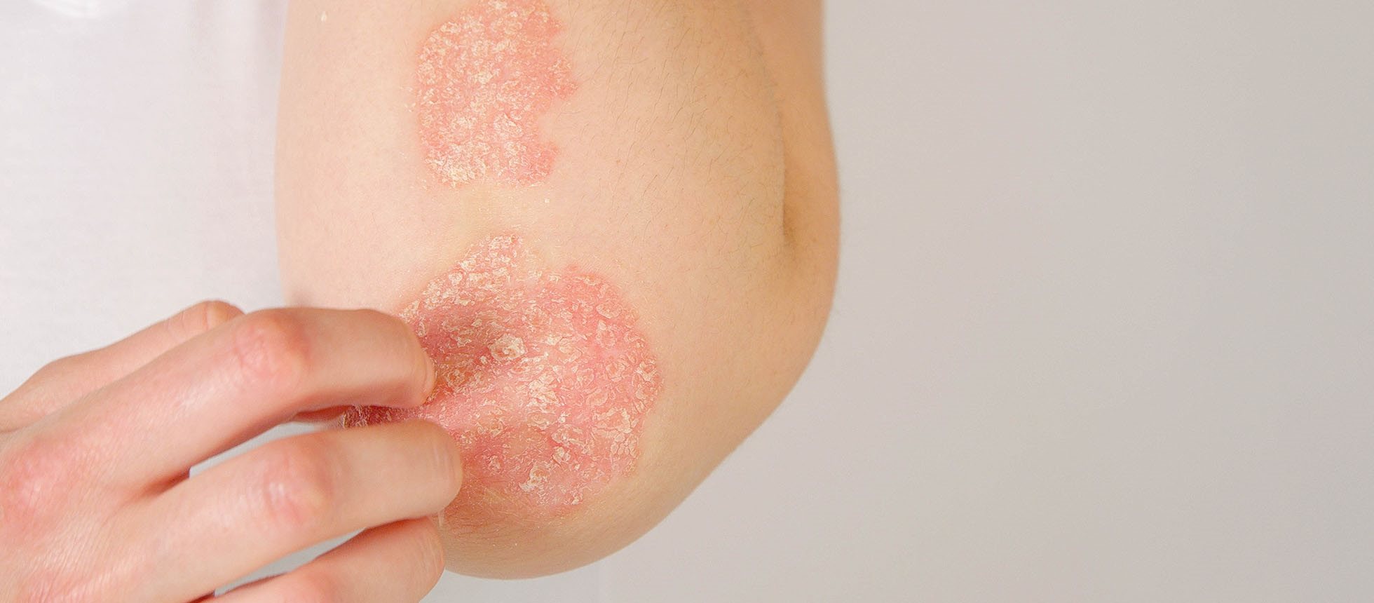 Frau mit Psoaris/Schuppenflechte kratzt sich am Ellenbogen