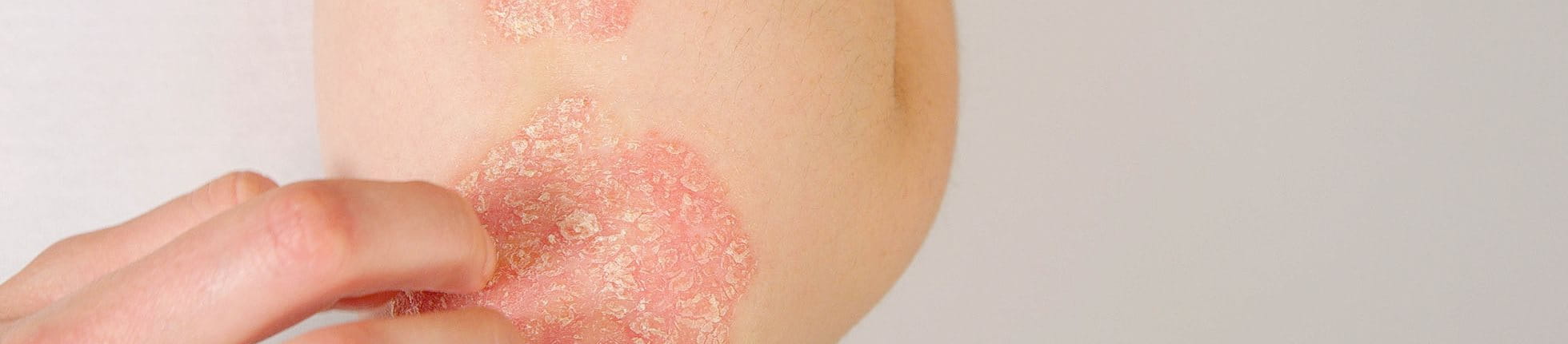 Frau mit Psoaris/Schuppenflechte kratzt sich am Ellenbogen