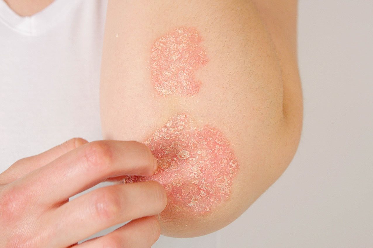 Dame mit Psoriasis - Schnuppenflechte kratzt sich am Ellbogen