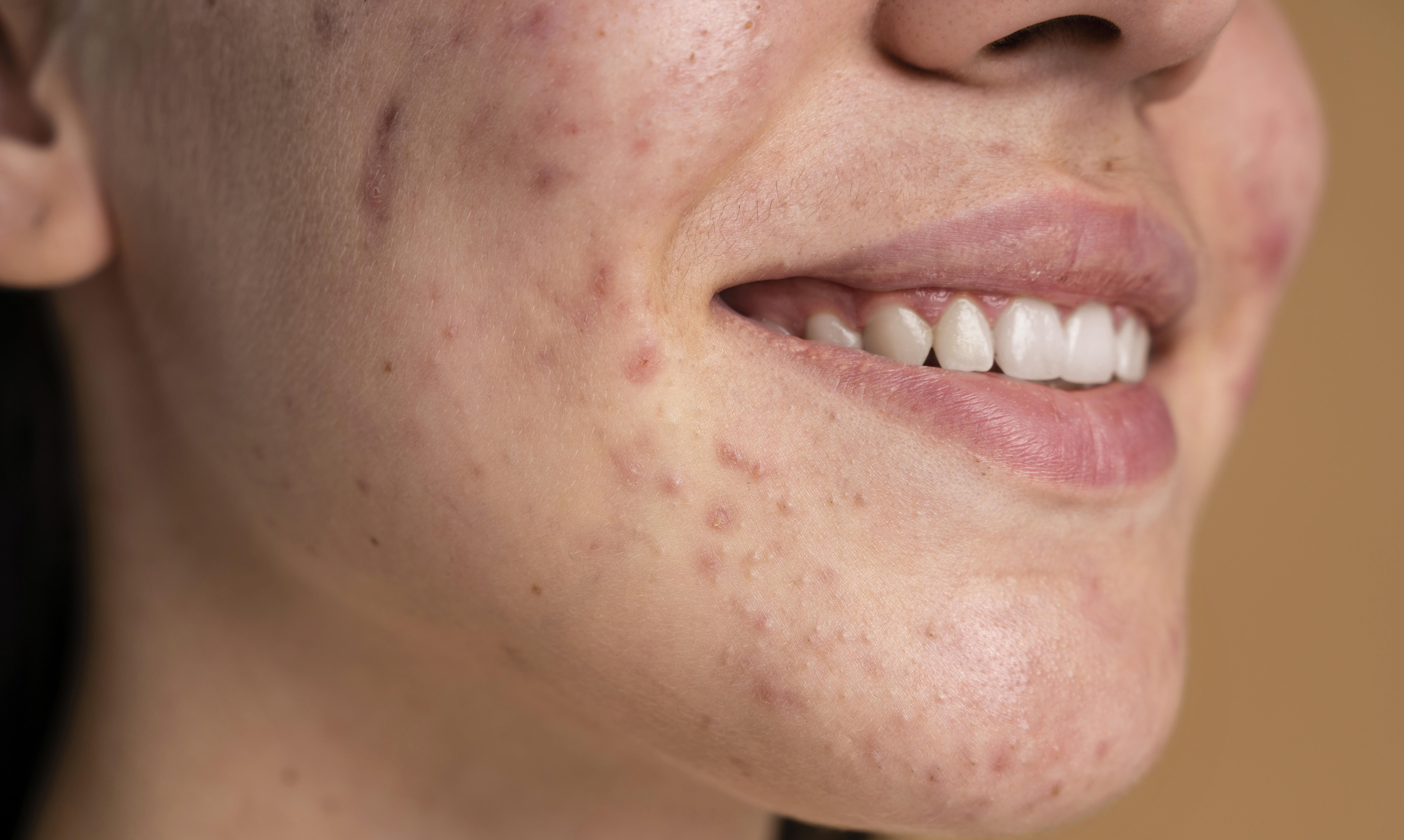 Ontsteking van de huid