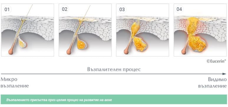 Микровъзпаление