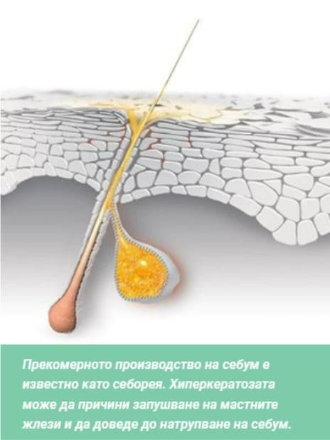 запушване на мастни жлези