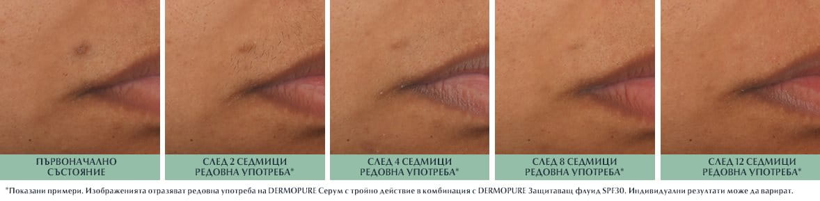 Кожа с ПИХ, проследяване на прогреса
