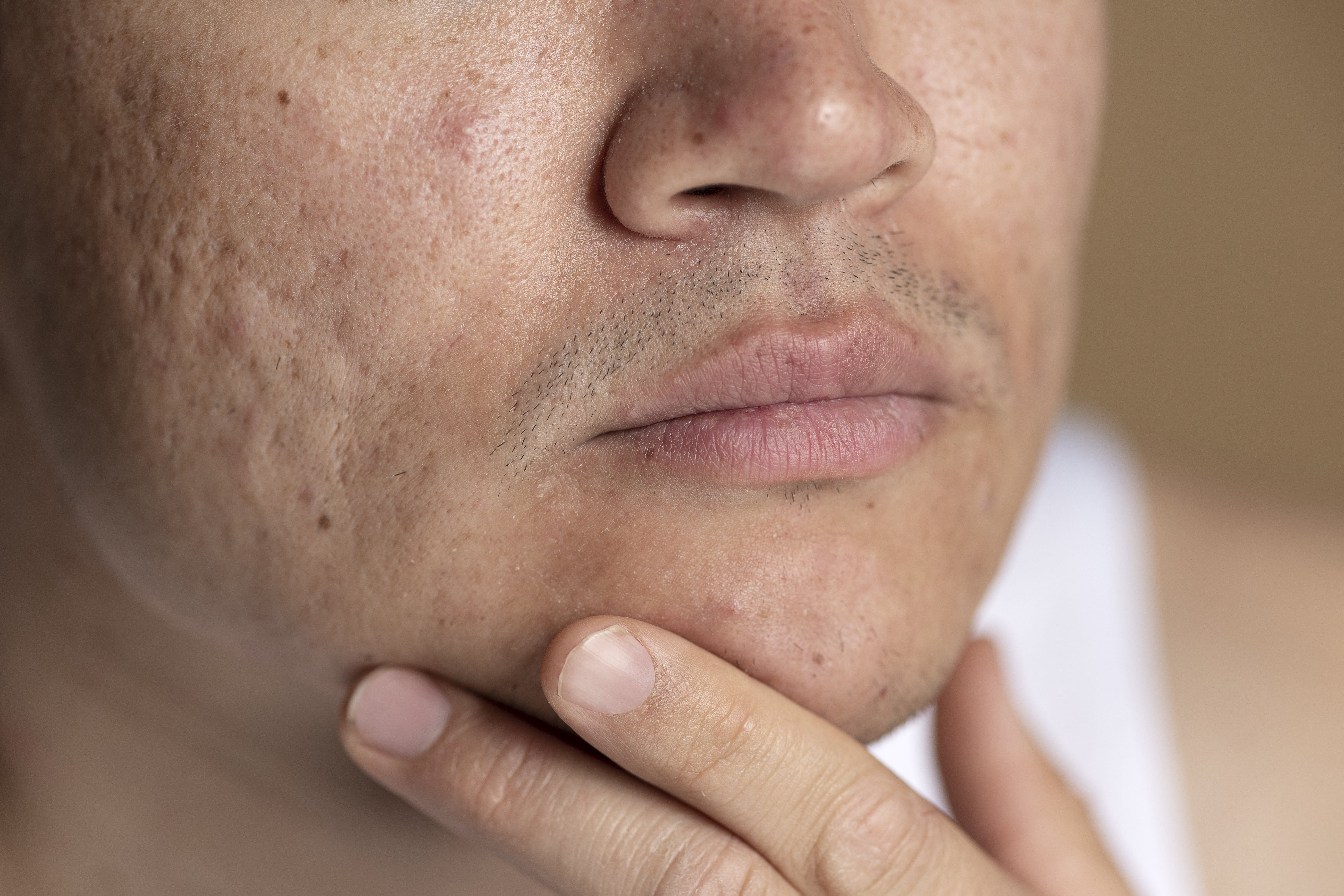 Clogged pores close up look