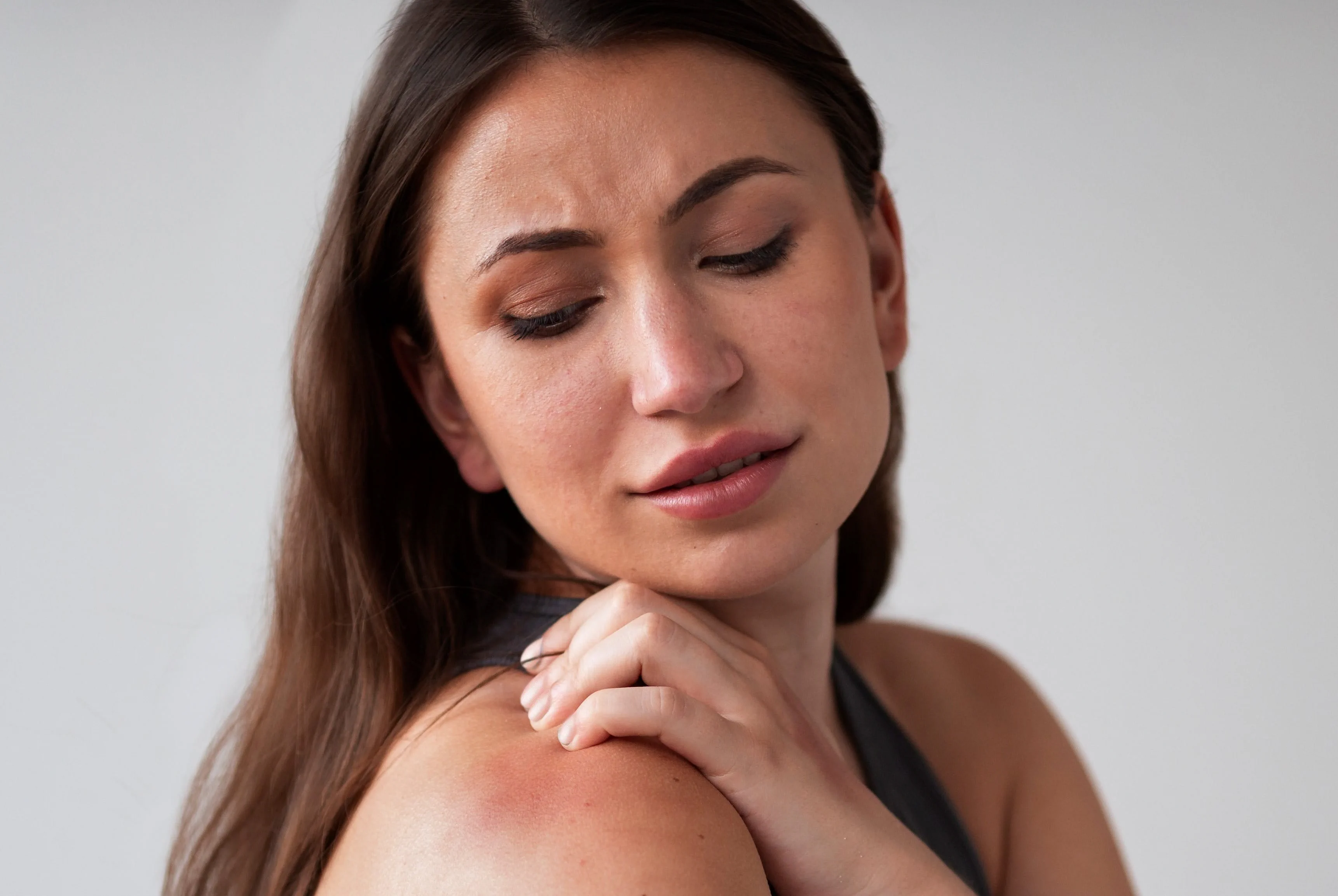 Woman suffering from sunburn