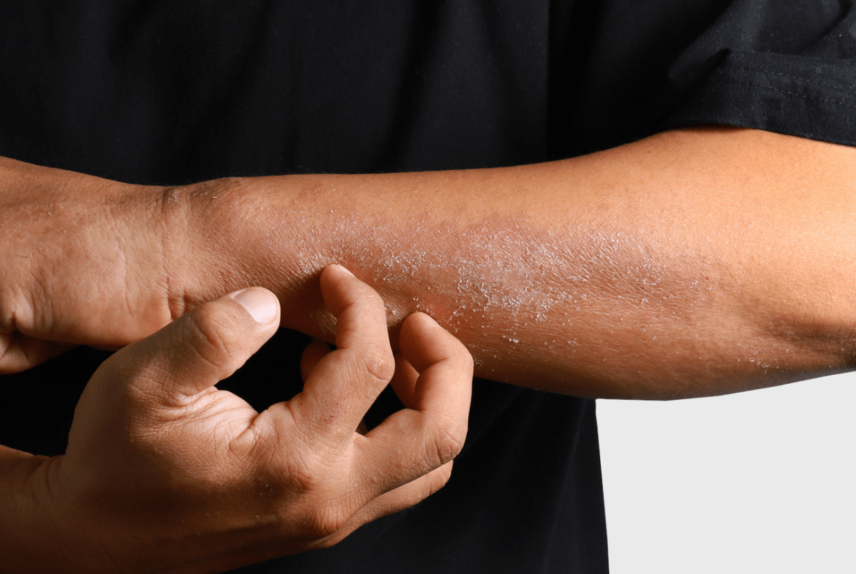 Contact dermatitis on hands