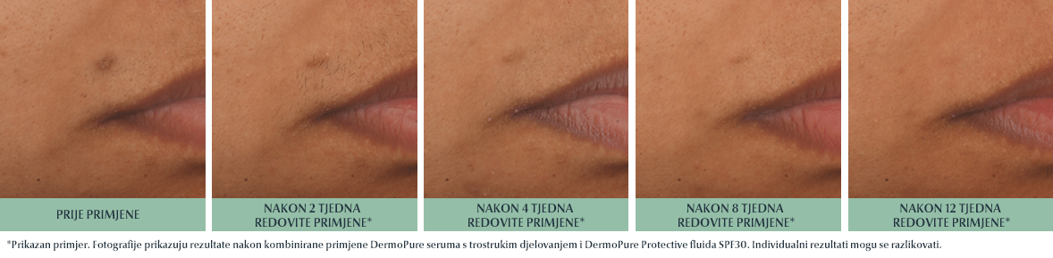 prikaz kože prije i nakon korištenja Eucerin DermoPure seruma trostrukog djelovanja