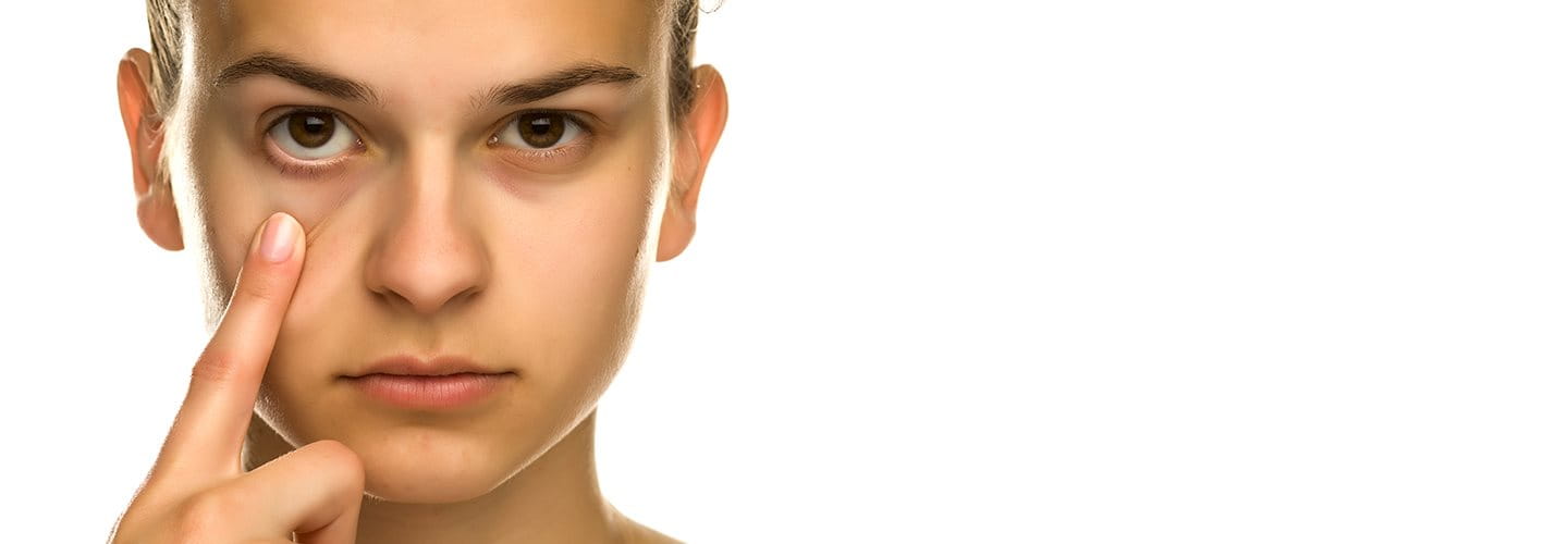 Occhiaie scure e borse sotto gli occhi