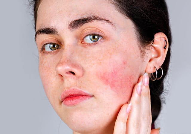 Macchie rosse sulla pelle con o senza prurito: le cause e cure