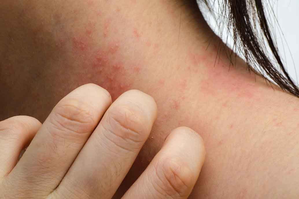 eczema sul collo