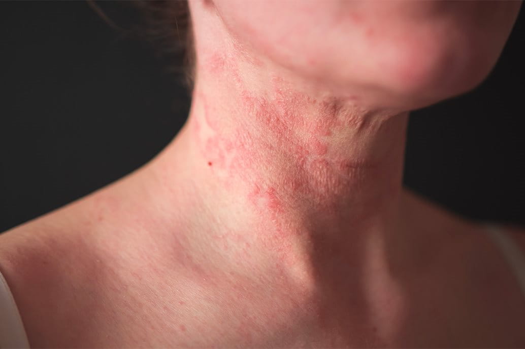 dermatite da stress sul collo e orticaria