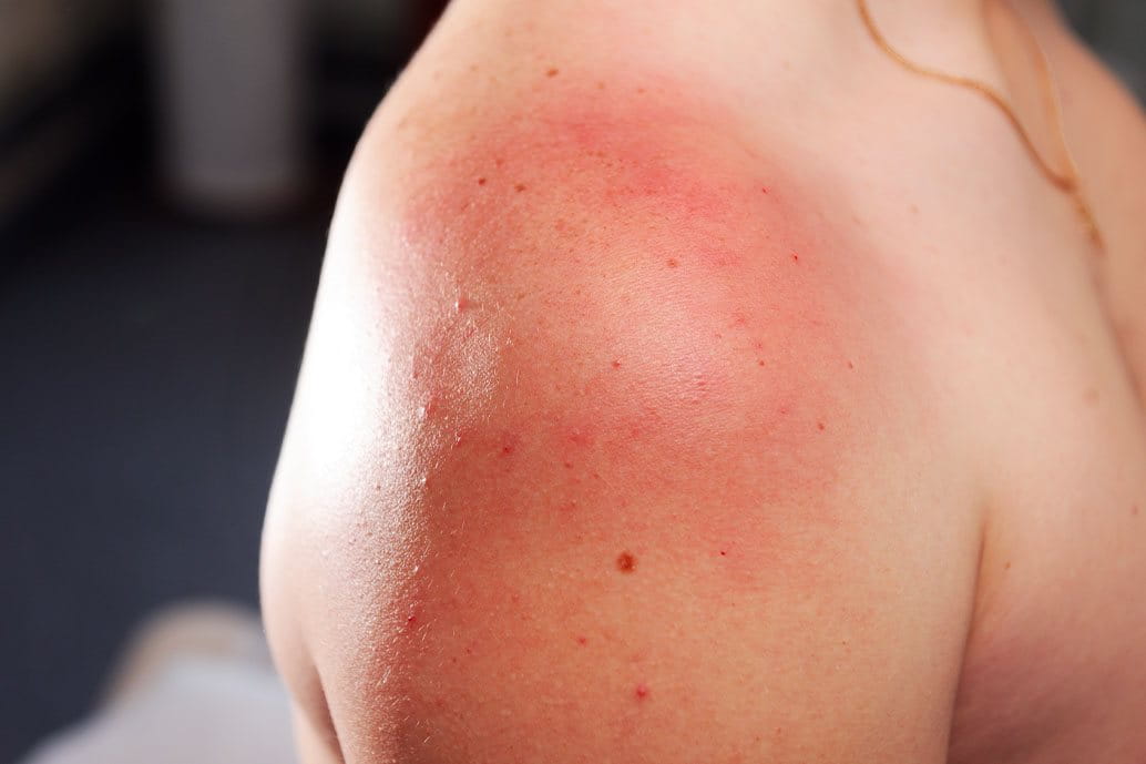 dermatite da stress, sfogo cutaneo sulla spalla