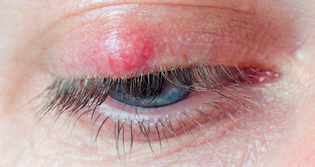 eczema sugli occhi