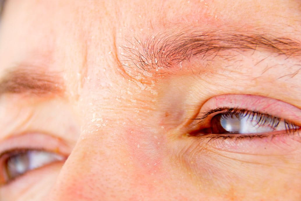 dermatite palpebrale su entrambi gli occhi