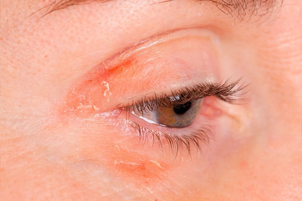 psoriasi sulle palpebre