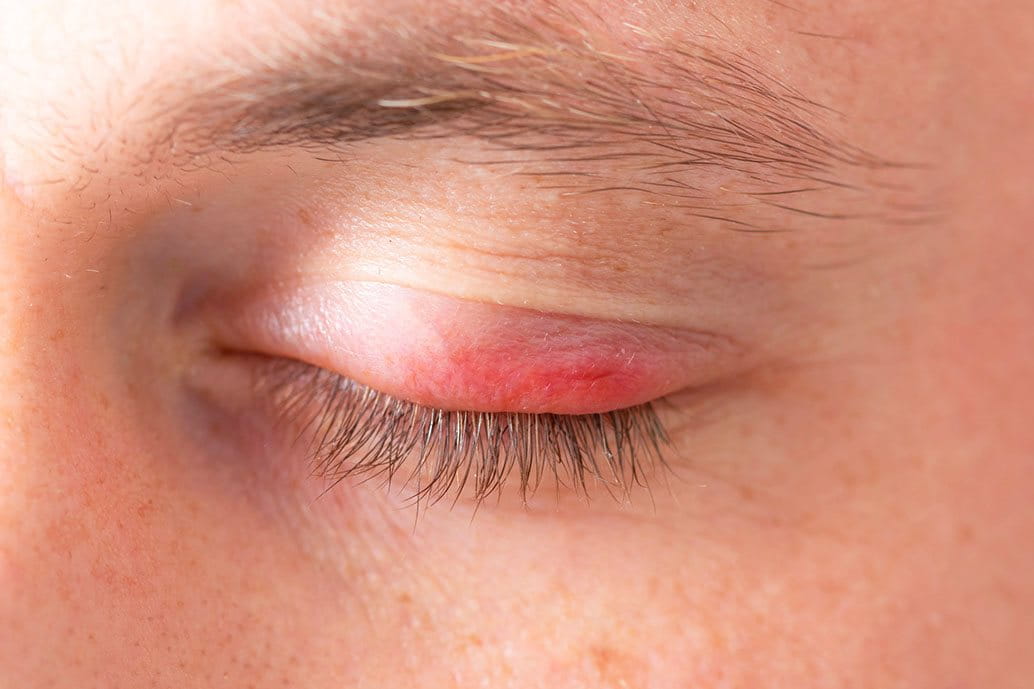 dermatite atopica sugli occhi