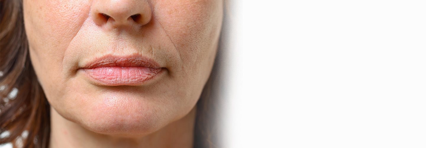Le rughe naso labiali compaiono ai bordi della bocca