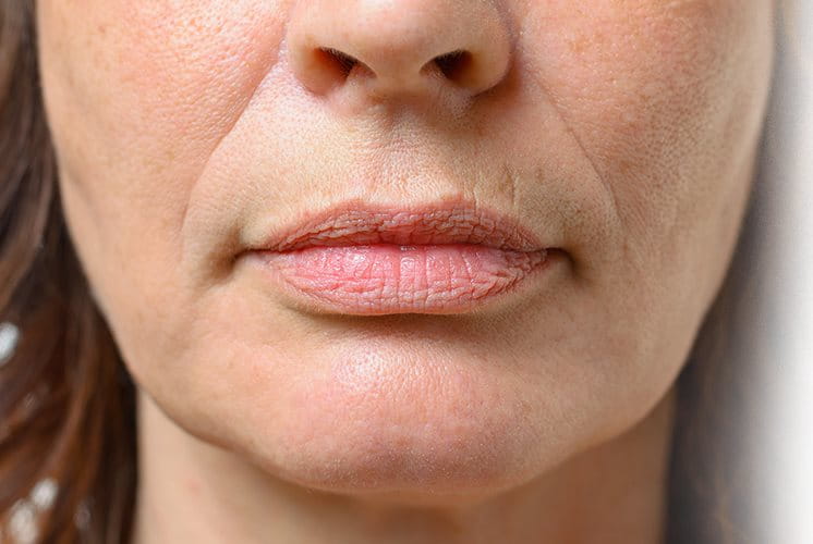 Le rughe naso labiali compaiono ai bordi della bocca
