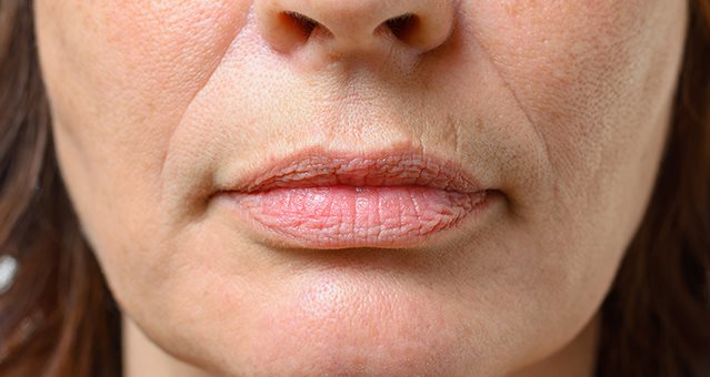 Le rughe naso labiali compaiono ai bordi della bocca