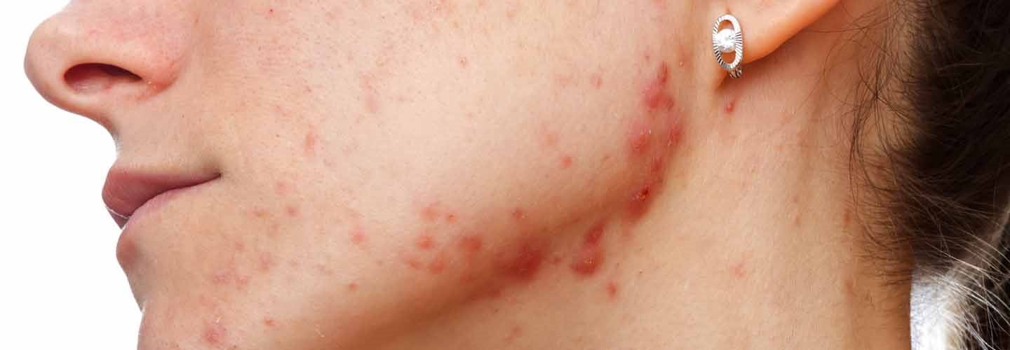 acne cistica